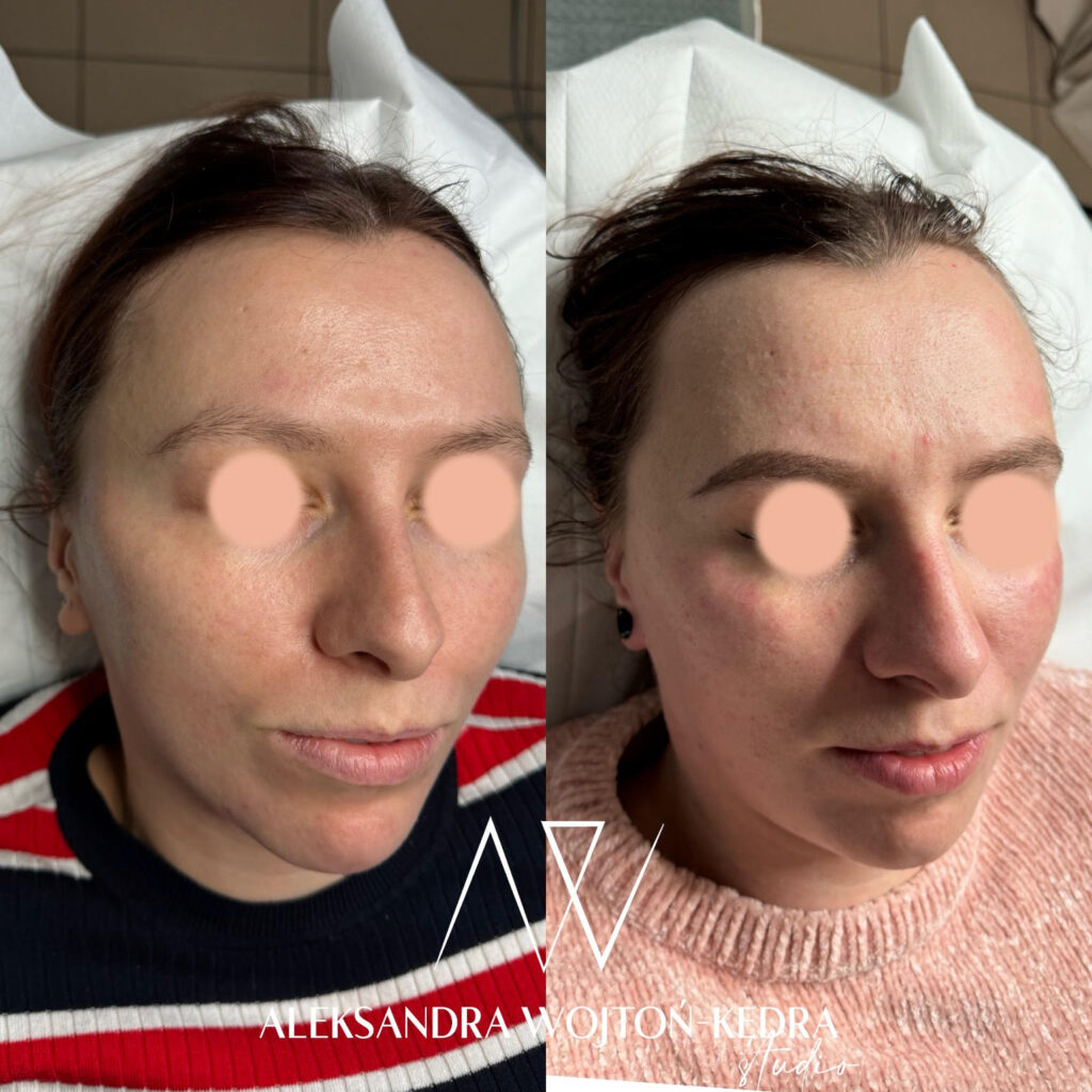 Aleksandra Wojtoń Kędra Stymulatory tkankowe zabieg w salonie Joanna Komenda Beauty Concept przed i po efekty