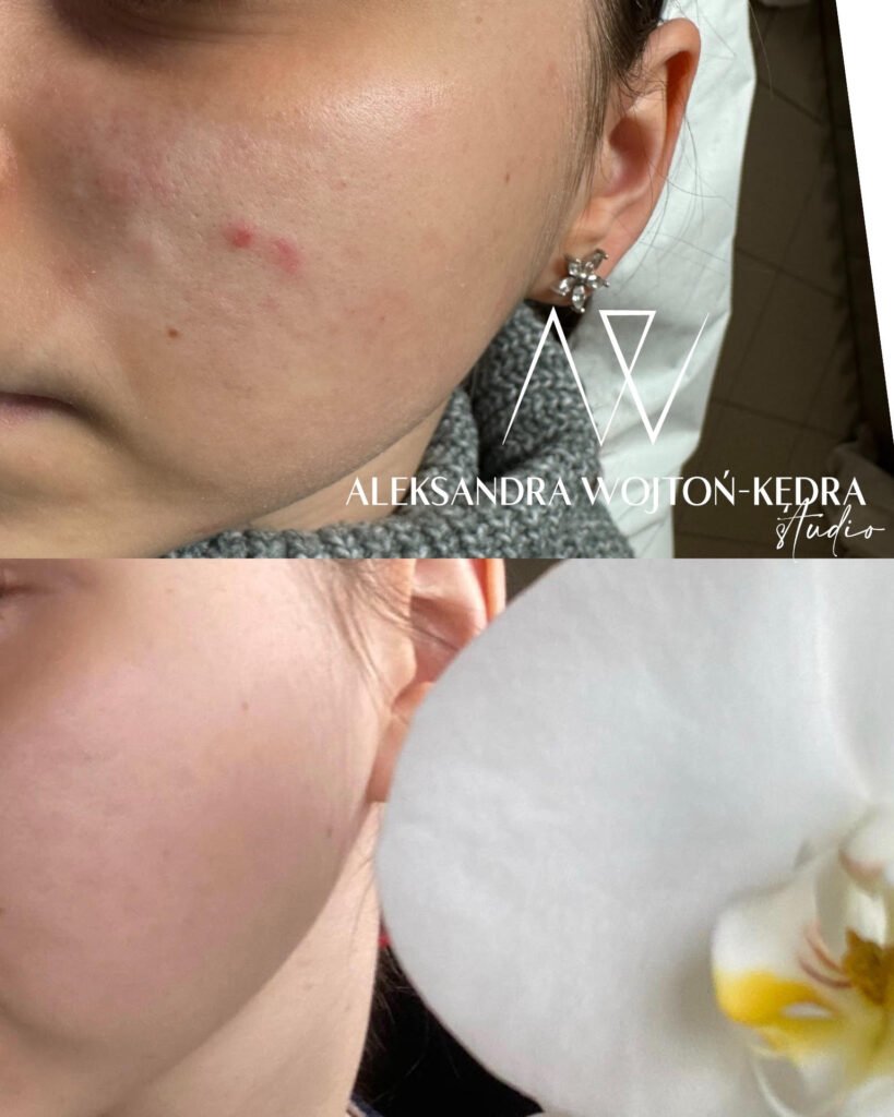 Aleksandra Wojtoń Kędra kosmetolog karboksyterapia kraków joanna komenda beauty concept kosmetologia estetyczna efekt przed i po 