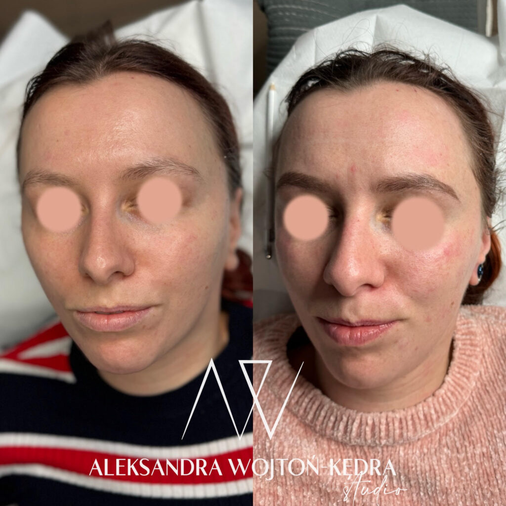 Aleksandra Wojtoń Kędra Stymulatory tkankowe zabieg w salonie Joanna Komenda Beauty Concept przed i po efekty