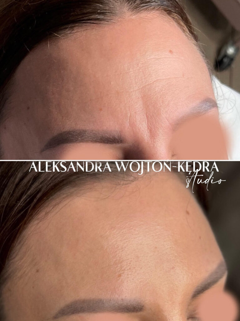 Aleksandra Wojtoń Kędra kosmetolog Radiofrekwencja mikroigłowa infite rf kraków joanna komenda beauty concept kosmetologia estetyczna efekt przed i po 