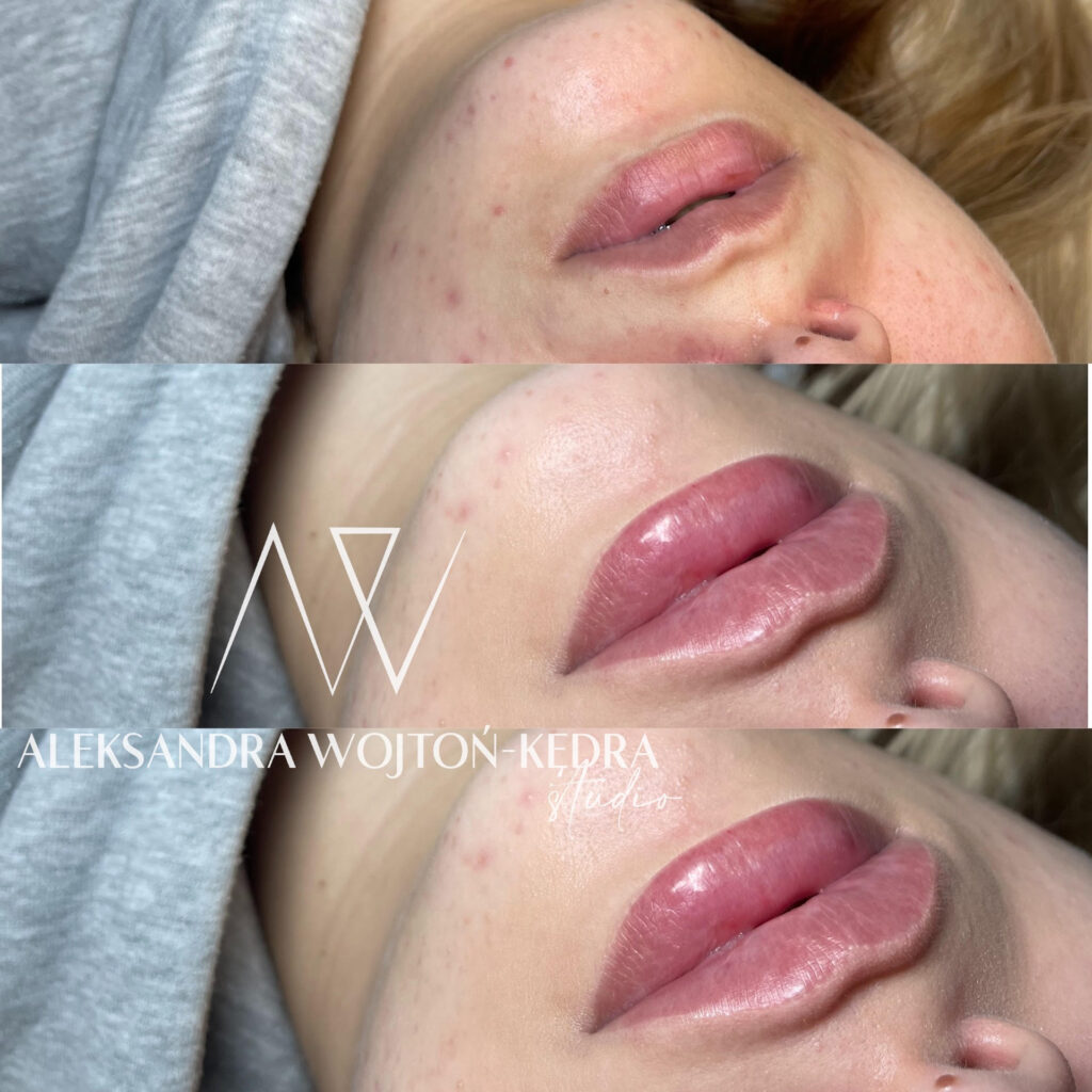 modelowanie ust kraków joanna komenda beauty concept aleksandra wojtoń kędra kosmetolog