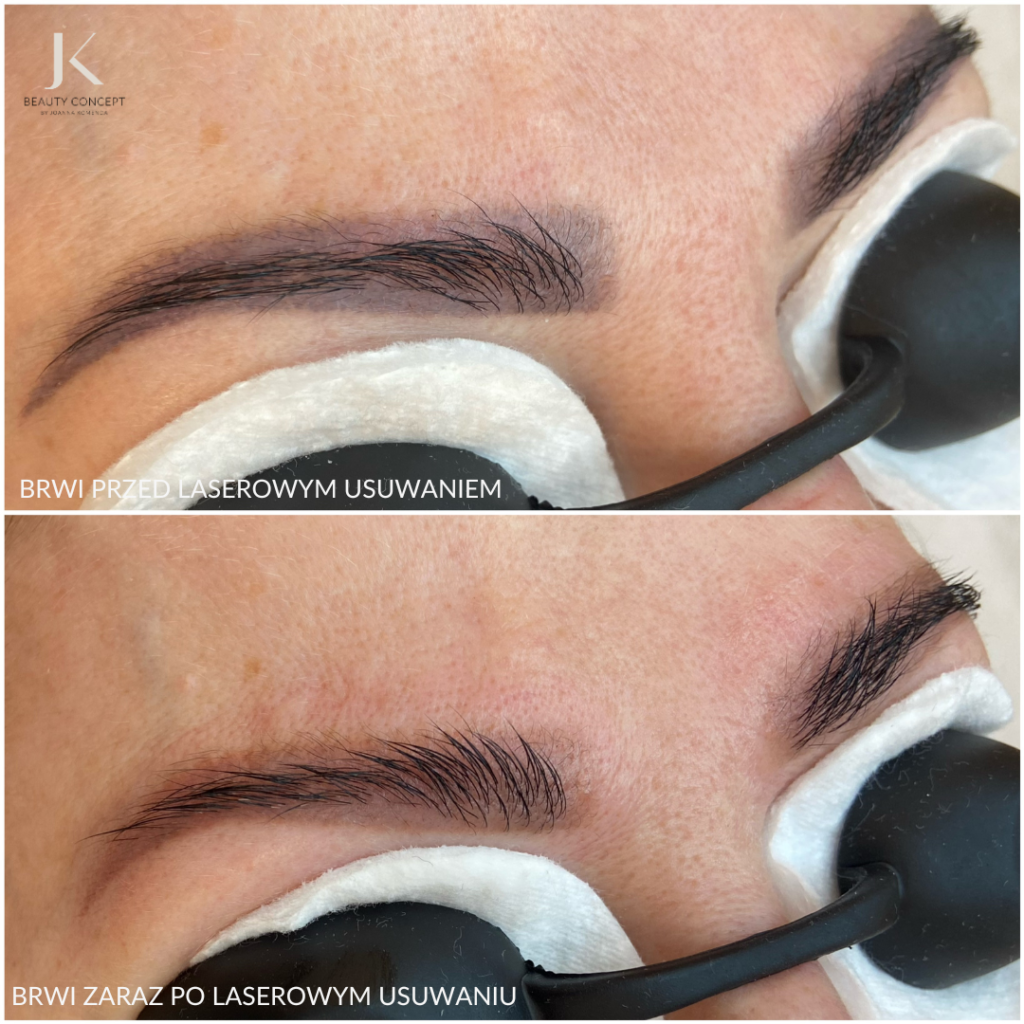 Joanna Komenda Beauty Concept Kraków Laserowe usuwanie brwi przed po